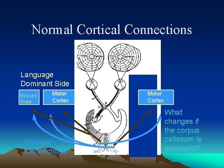 Normal Cortical Connections Language Dominant Side Broca’s Area Motor Cortex Callosal Connections Motor Cortex