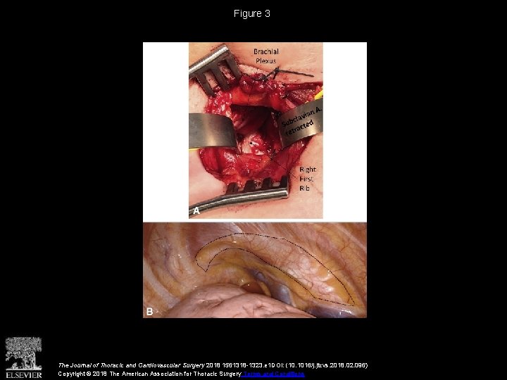 Figure 3 The Journal of Thoracic and Cardiovascular Surgery 2018 1561318 -1323. e 1