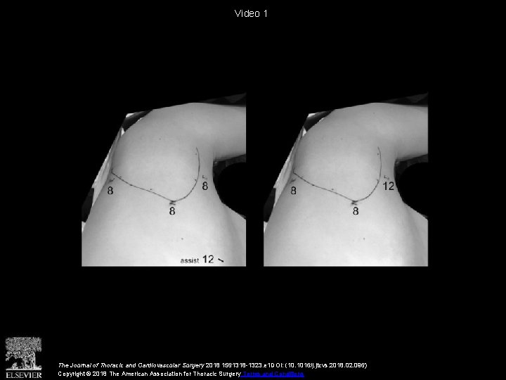Video 1 The Journal of Thoracic and Cardiovascular Surgery 2018 1561318 -1323. e 1