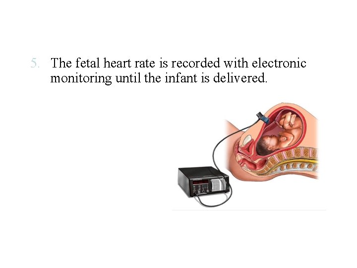5. The fetal heart rate is recorded with electronic monitoring until the infant is