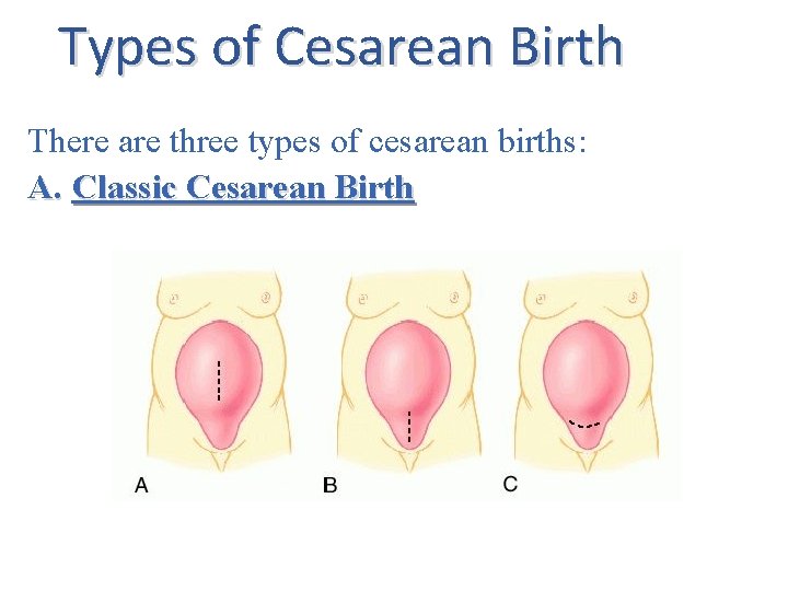 Types of Cesarean Birth There are three types of cesarean births: A. Classic Cesarean