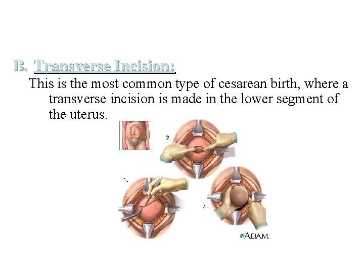B. Transverse Incision: This is the most common type of cesarean birth, where a