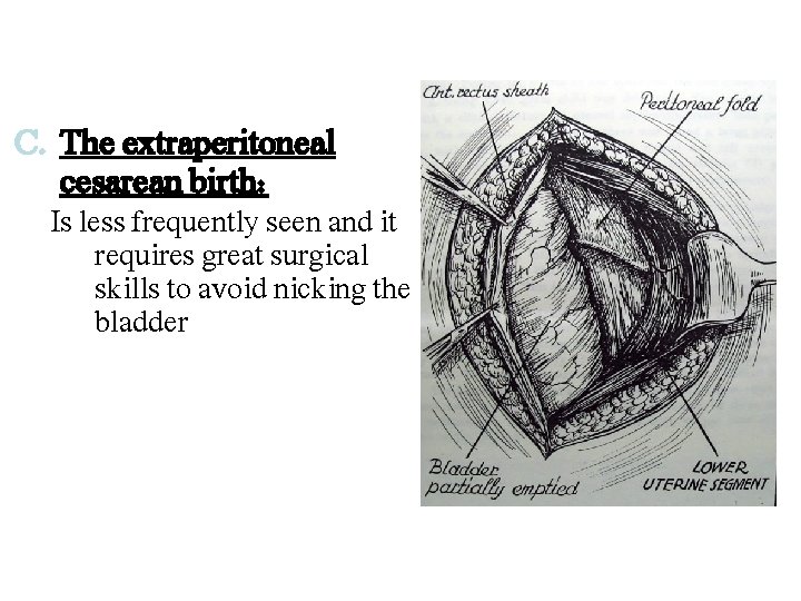 C. The extraperitoneal cesarean birth: Is less frequently seen and it requires great surgical