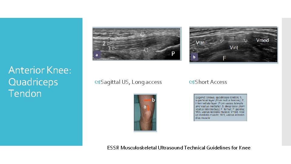 Anterior Knee: Quadriceps Tendon Sagittal US, Long access Short Access ESSR Musculoskeletal Ultrasound Technical