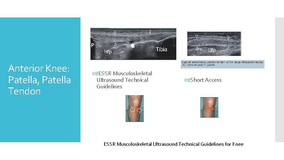 Anterior Knee: Patella, Patella Tendon ESSR Musculoskeletal Ultrasound Technical Guidelines Short Access ESSR Musculoskeletal