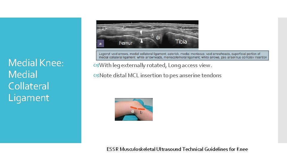 Medial Knee: Medial Collateral Ligament With leg externally rotated, Long access view. Note distal