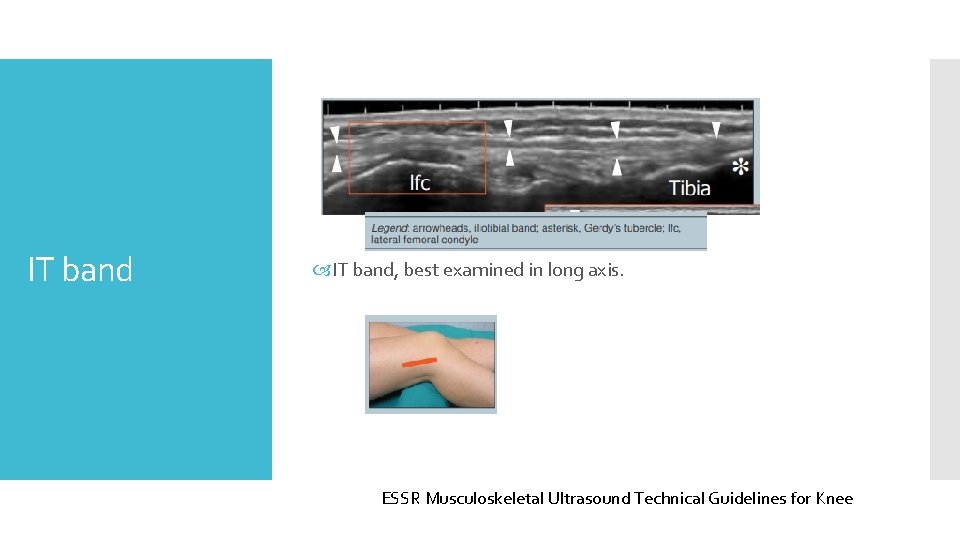 IT band IT band, best examined in long axis. ESSR Musculoskeletal Ultrasound Technical Guidelines