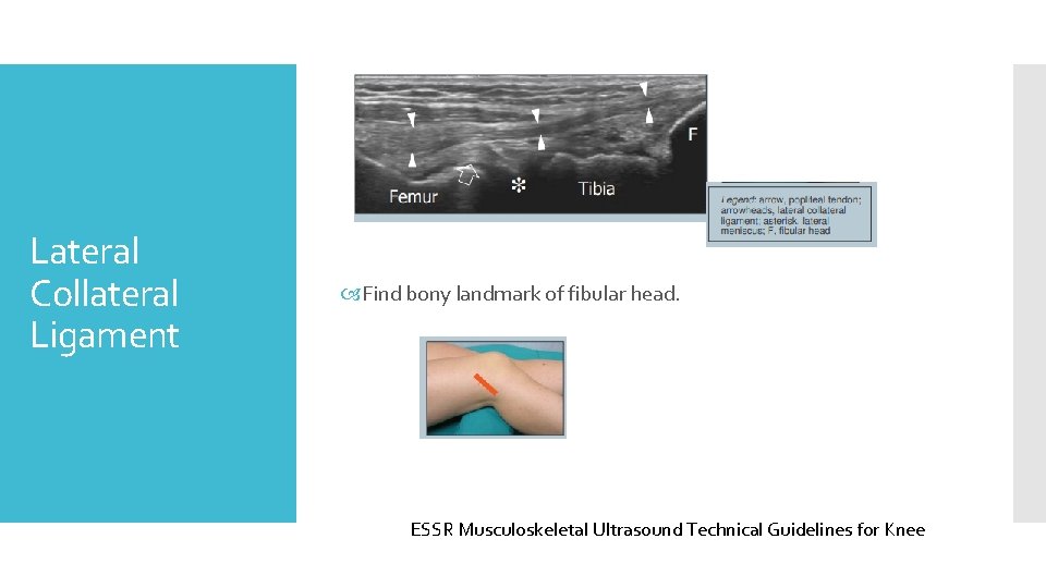 Lateral Collateral Ligament Find bony landmark of fibular head. ESSR Musculoskeletal Ultrasound Technical Guidelines