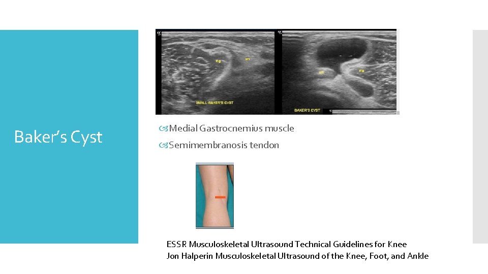 Baker’s Cyst Medial Gastrocnemius muscle Semimembranosis tendon ESSR Musculoskeletal Ultrasound Technical Guidelines for Knee