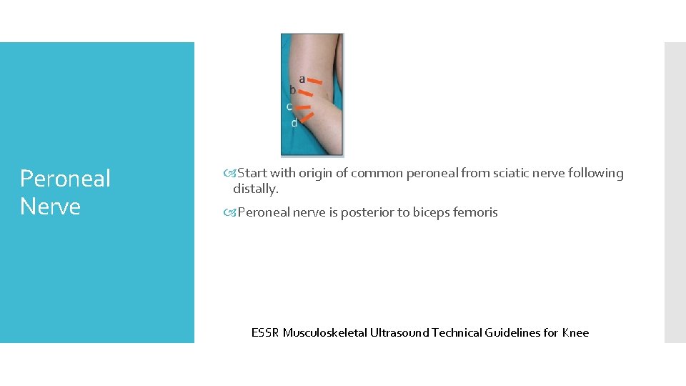 Peroneal Nerve Start with origin of common peroneal from sciatic nerve following distally. Peroneal