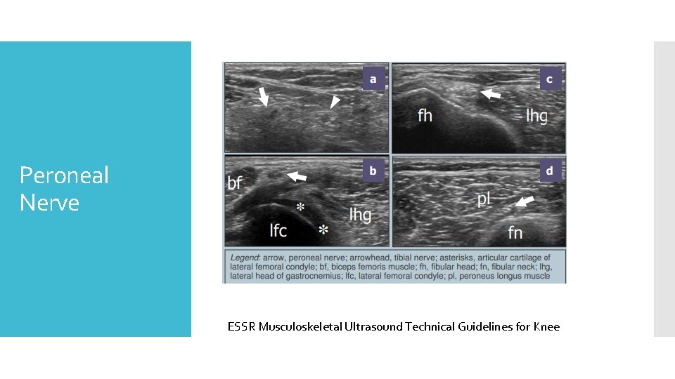 Peroneal Nerve ESSR Musculoskeletal Ultrasound Technical Guidelines for Knee 