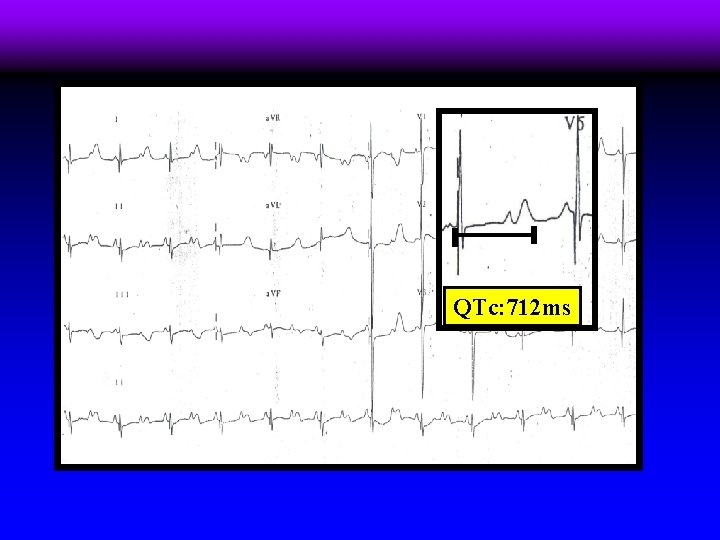 QTc: 712 ms 