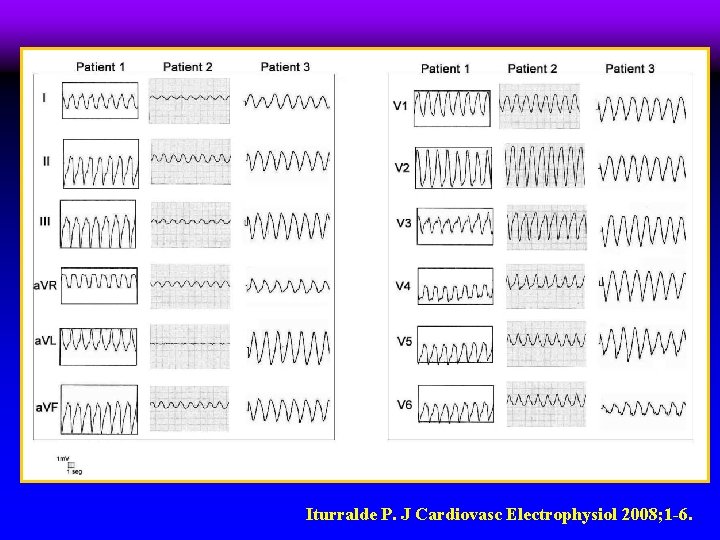 Iturralde P. J Cardiovasc Electrophysiol 2008; 1 -6. 