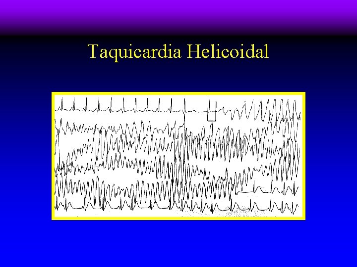 Taquicardia Helicoidal 