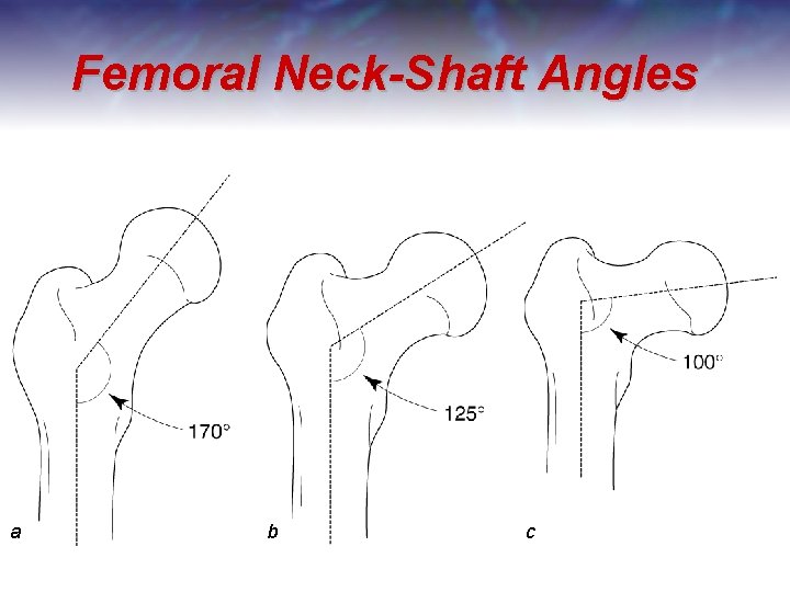 Femoral Neck-Shaft Angles a b c 