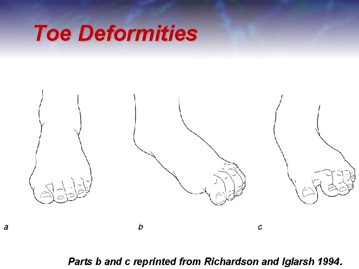 Toe Deformities Parts b and c reprinted from Richardson and Iglarsh 1994. 