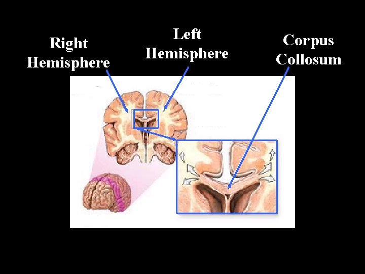 Right Hemisphere Left Hemisphere Corpus Collosum 