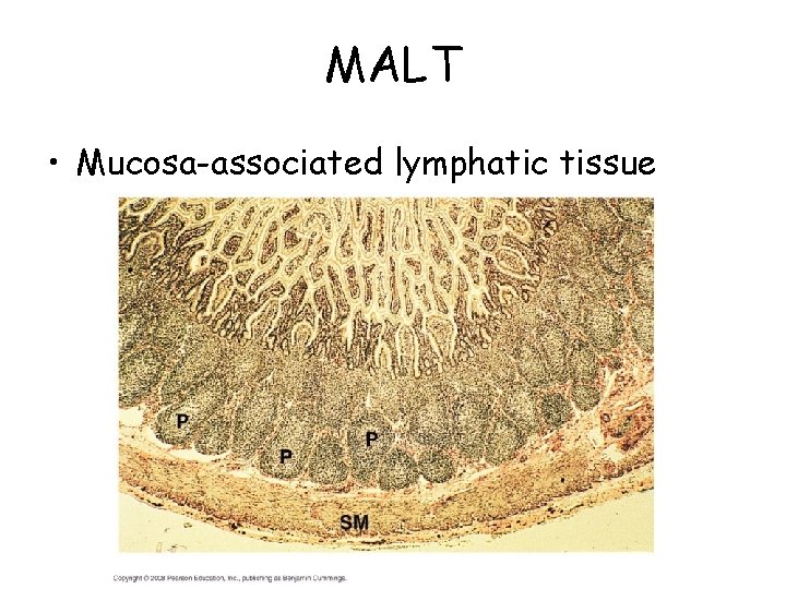 MALT • Mucosa-associated lymphatic tissue 