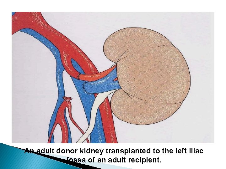 An adult donor kidney transplanted to the left iliac fossa of an adult recipient.