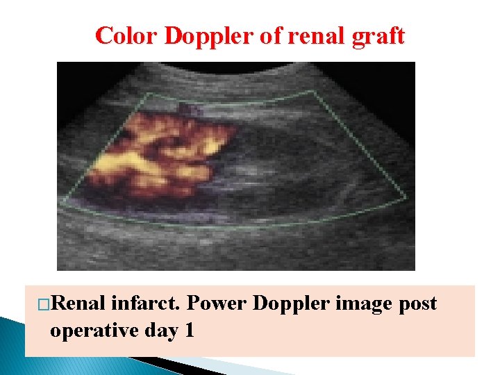 Color Doppler of renal graft �Renal infarct. Power Doppler image post operative day 1