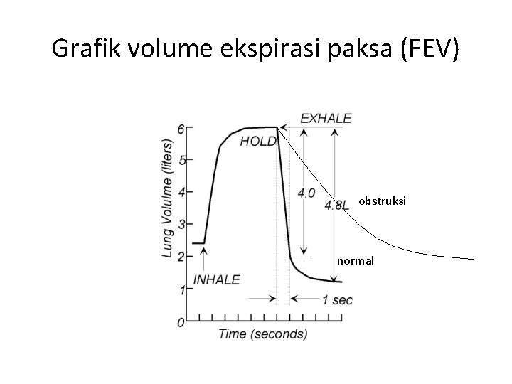 Grafik volume ekspirasi paksa (FEV) obstruksi normal 