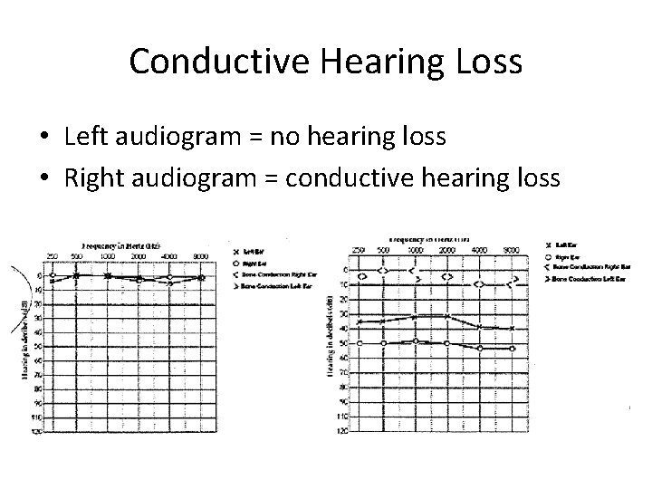 Conductive Hearing Loss • Left audiogram = no hearing loss • Right audiogram =