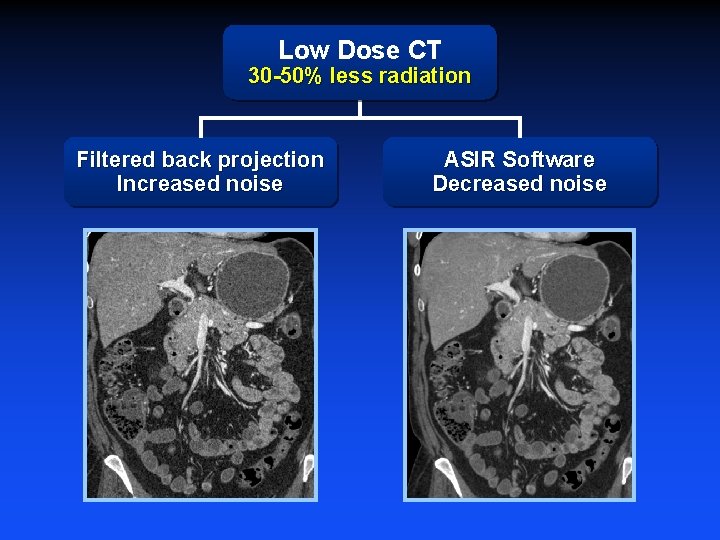 Low Dose CT 30 -50% less radiation Filtered back projection Increased noise ASIR Software