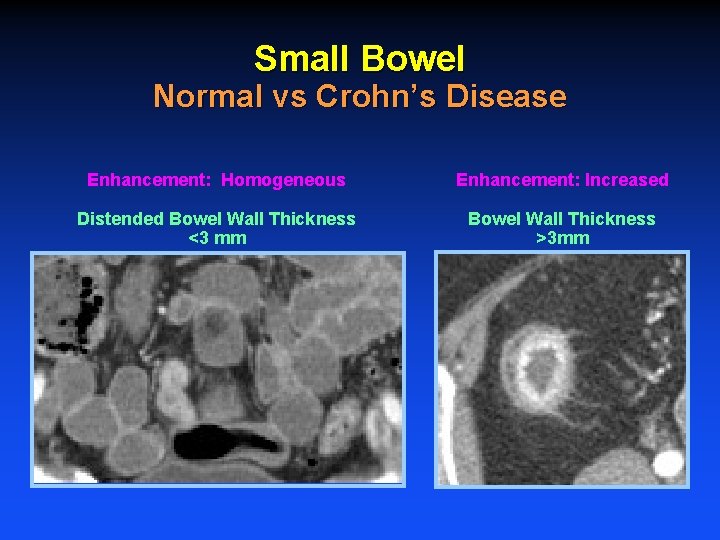 Small Bowel Normal vs Crohn’s Disease Enhancement: Homogeneous Enhancement: Increased Distended Bowel Wall Thickness
