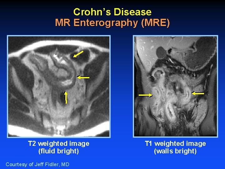 Crohn’s Disease MR Enterography (MRE) T 2 weighted image (fluid bright) Courtesy of Jeff