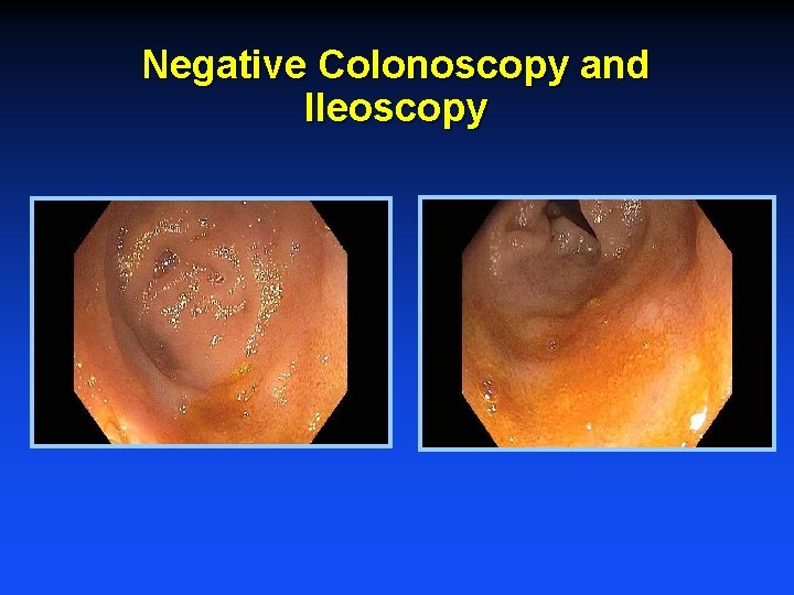 Negative Colonoscopy and Ileoscopy 