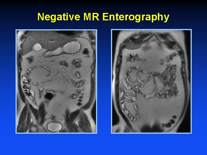 Negative MR Enterography 