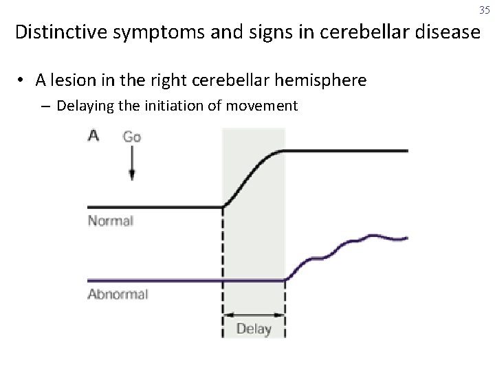 35 Distinctive symptoms and signs in cerebellar disease • A lesion in the right