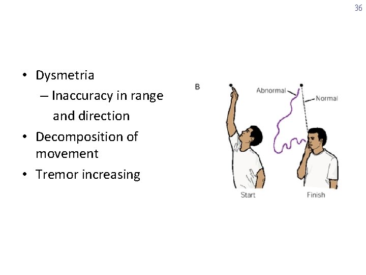36 • Dysmetria – Inaccuracy in range and direction • Decomposition of movement •