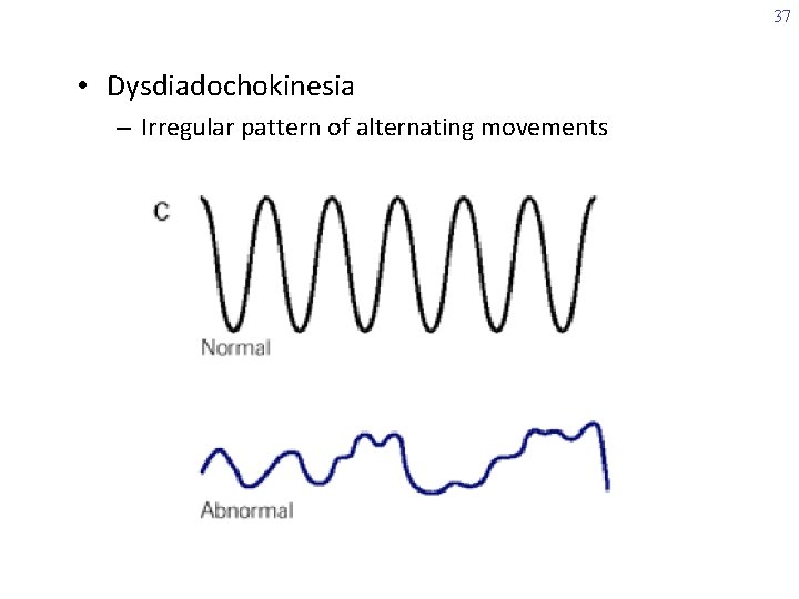37 • Dysdiadochokinesia – Irregular pattern of alternating movements 