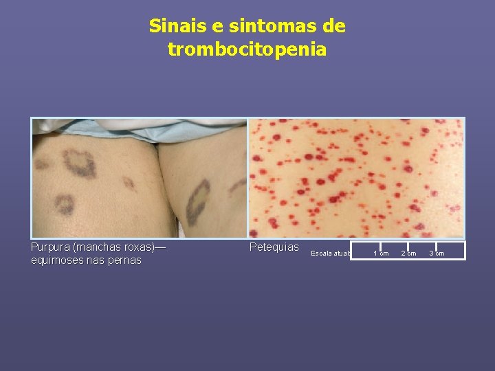 Sinais e sintomas de trombocitopenia Purpura (manchas roxas)— equimoses nas pernas Petequias Escala atual: