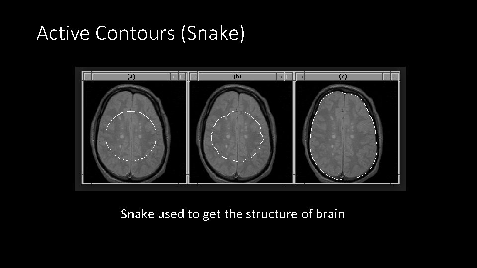 Active Contours (Snake) Snake used to get the structure of brain 