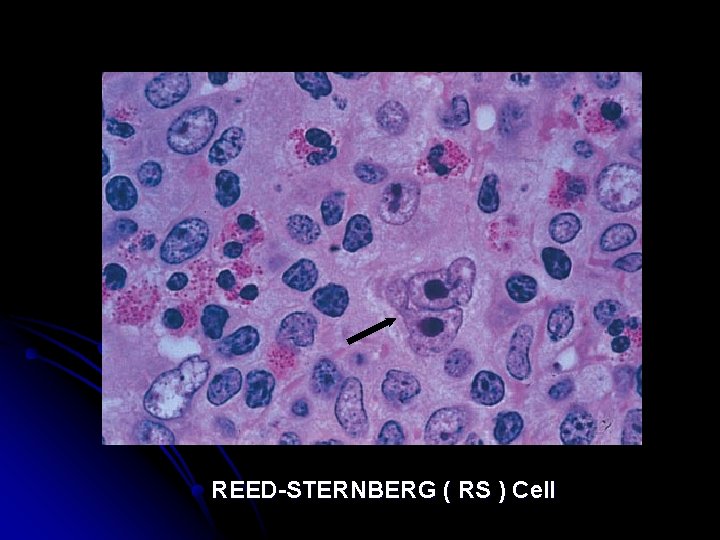 REED-STERNBERG ( RS ) Cell 