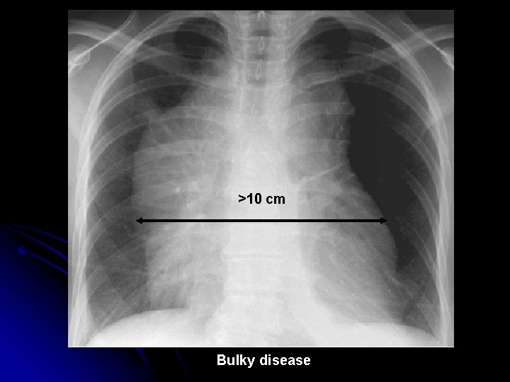 >10 cm Bulky disease 
