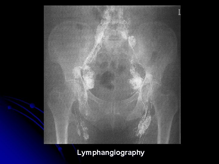 Lymphangiography 