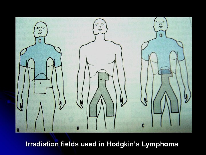 Irradiation fields used in Hodgkin’s Lymphoma 