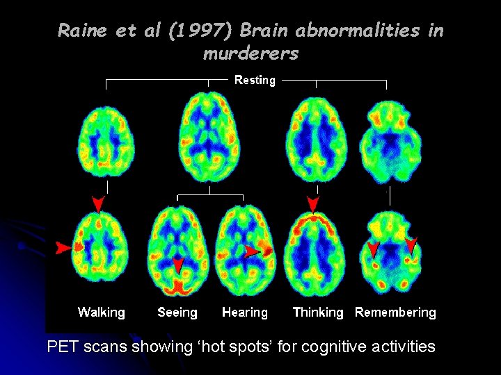 Raine et al (1997) Brain abnormalities in murderers PET scans showing ‘hot spots’ for