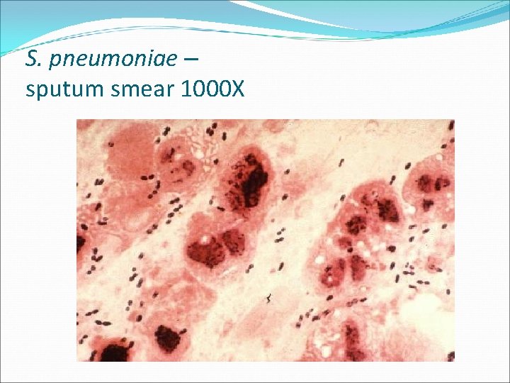 S. pneumoniae – sputum smear 1000 X 