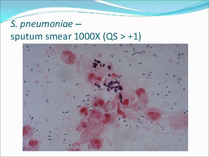 S. pneumoniae – sputum smear 1000 X (QS > +1) 