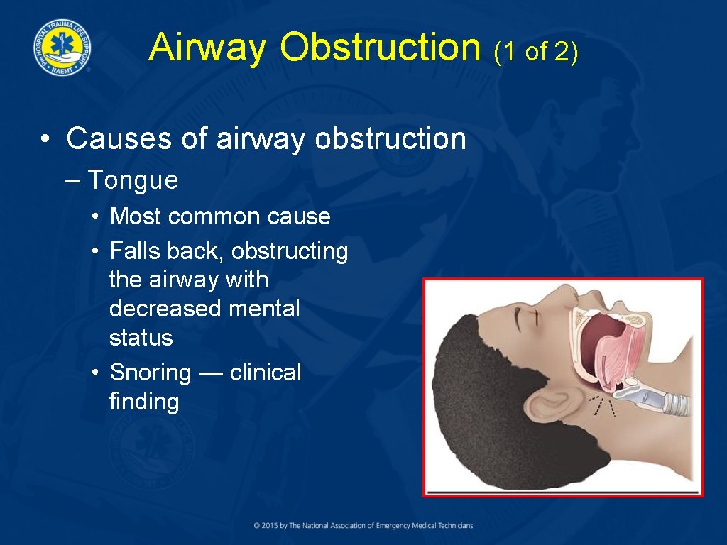 Airway Obstruction (1 of 2) • Causes of airway obstruction – Tongue • Most