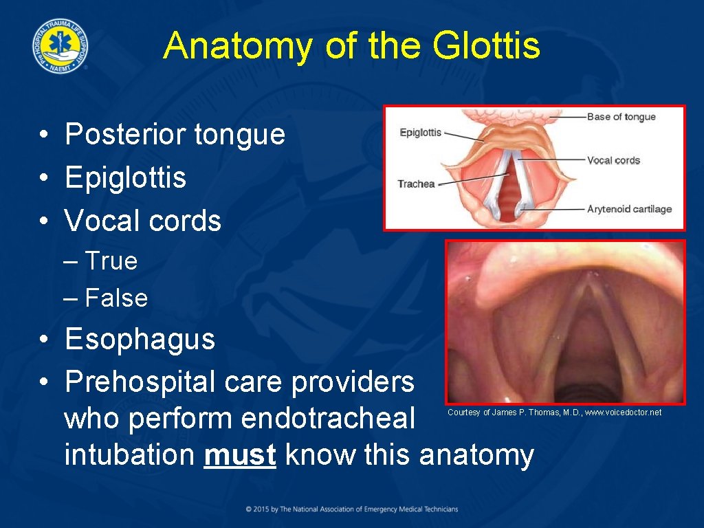 Anatomy of the Glottis • Posterior tongue • Epiglottis • Vocal cords – True