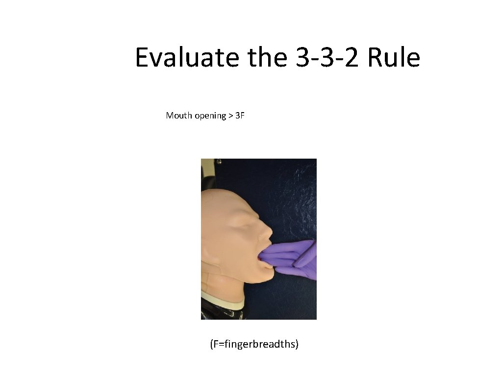 Evaluate the 3 -3 -2 Rule Mouth opening > 3 F (F=fingerbreadths) 