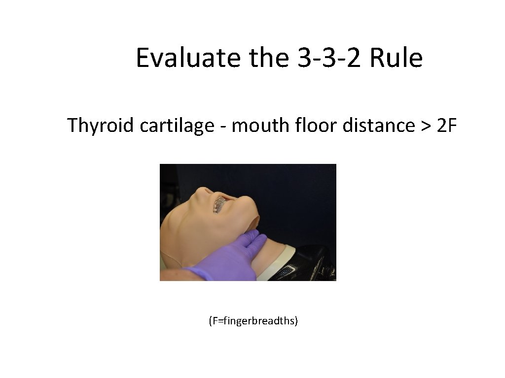 Evaluate the 3 -3 -2 Rule Thyroid cartilage - mouth floor distance > 2