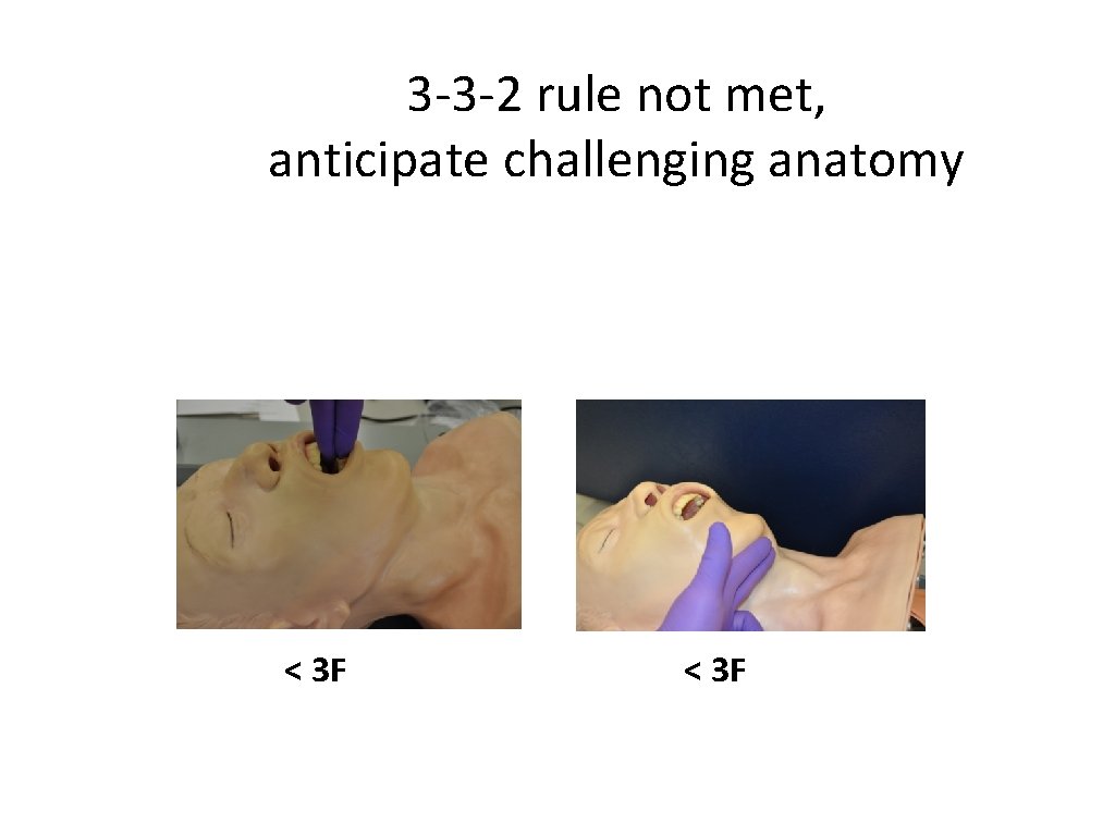 3 -3 -2 rule not met, anticipate challenging anatomy < 3 F 