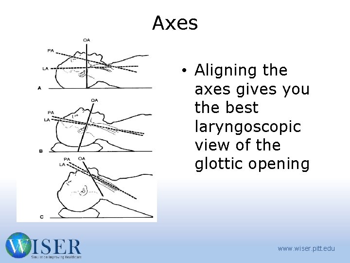 Axes • Aligning the axes gives you the best laryngoscopic view of the glottic