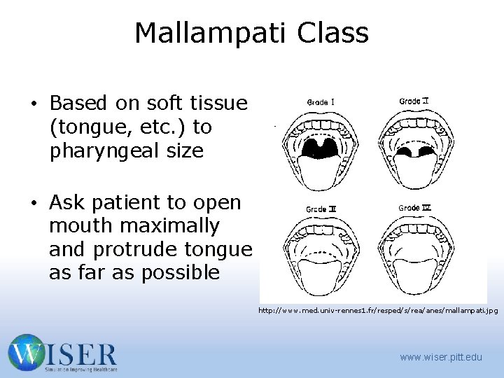 Mallampati Class • Based on soft tissue (tongue, etc. ) to pharyngeal size •
